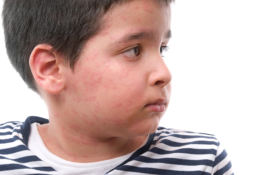 heat rash on face toddler